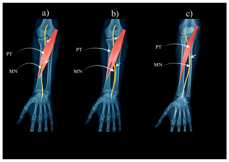 Three pronator teres morphologies and their relationship to the median nerve