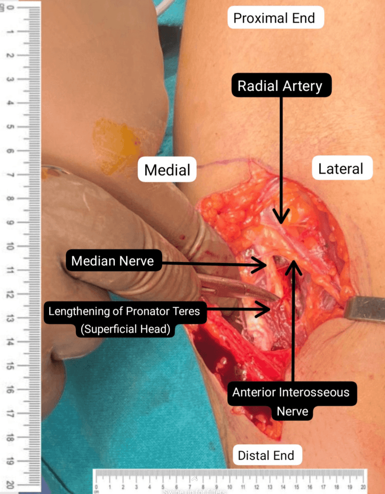 Labelled exposure showing lengthening of the superficial head of pronator teres with the median nerve, anterior interosseous nerve and radial artery