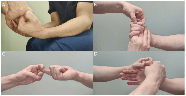 Four panels, A to D, of resisted strength testing of median-innervated muscles for subtle proximal median nerve weakness