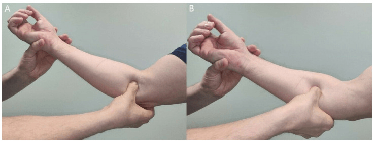 Two panels, A and B, of focal thumb pressure at different points over the proximal median nerve near the elbow