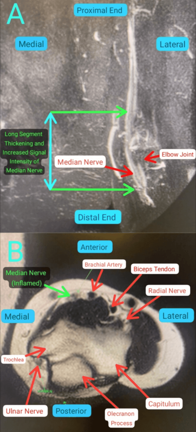 Coronal and axial fluid-sensitive MRI of the elbow showing an 11 cm segment of thickened, hyperintense median nerve