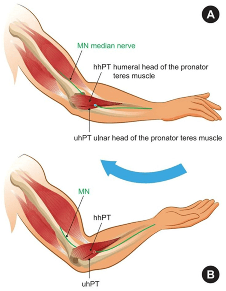 Schematic of the median nerve between the humeral and ulnar heads of pronator teres in two forearm positions, A and B