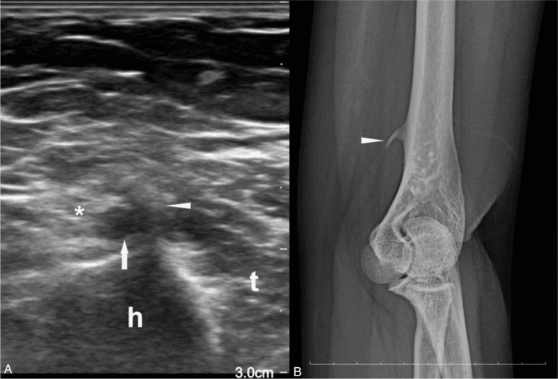 Ultrasound and oblique radiograph of a humeral supracondylar process