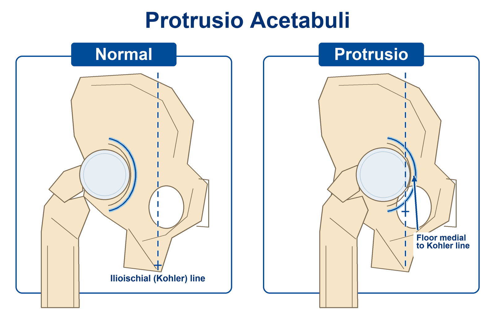 Diagram of the radiographic diagnosis of protrusio acetabuli: the acetabular floor projecting medial to the ilioischial (Kohler) line.