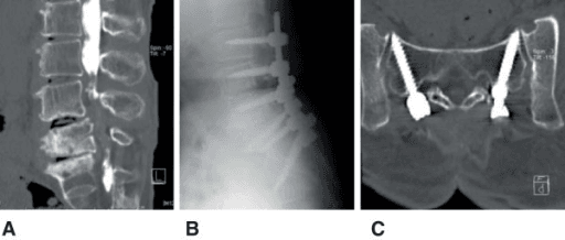 Three-panel CT and postoperative radiographic images from a 67-year-old woman with proximal junctional kyphosis after lumbar fusion