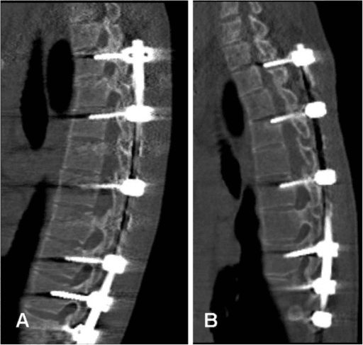 Sagittal CT comparison showing upper-construct screw loosening and pull-out after scoliosis instrumentation