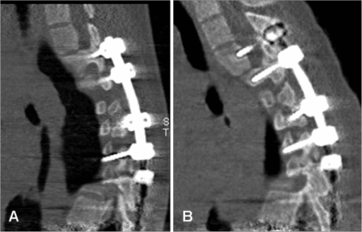 Paired sagittal CT images showing proximal junctional kyphosis above a thoracic fusion at two-year follow-up