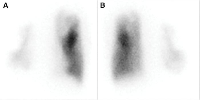 Perfusion scintigraphy in two projections showing one lung almost unperfused in giant bullous disease