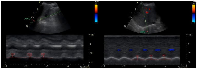 M-mode ultrasound tracings measuring diaphragmatic excursion in two panels, with three excursions marked in each