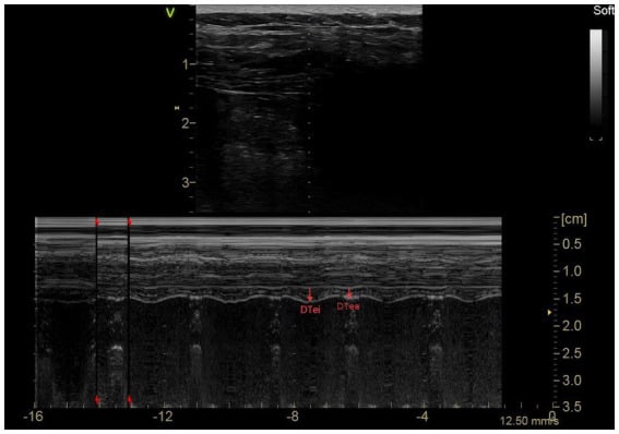 M-mode ultrasound measuring inspiratory and expiratory diaphragm thickness (DTei, DTee)