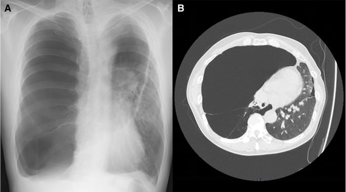Chest radiograph and CT showing a giant right-sided bulla with the mediastinum displaced to the left