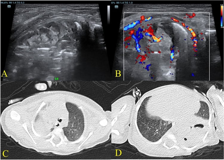 Lung ultrasound with colour Doppler and CT showing consolidation with pulmonary abscess formation