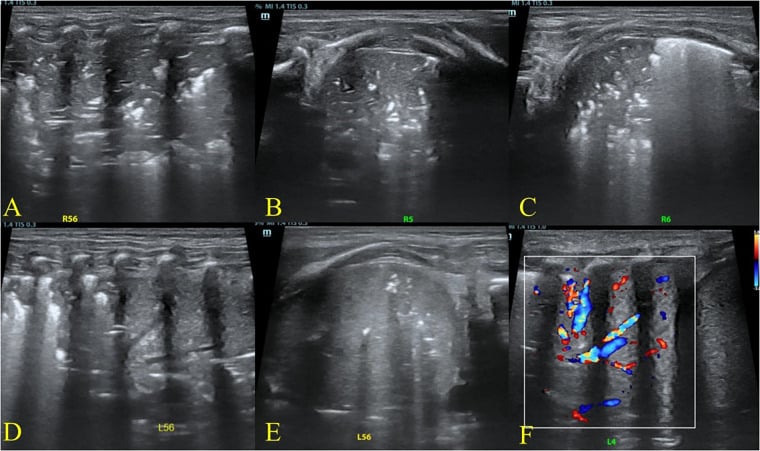 Six lung ultrasound panels (A-F) from right and left zones showing consolidation with air bronchograms and colour Doppler flow