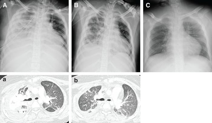 Serial chest radiographs and CT showing right-sided postoperative atelectasis clearing after treatment