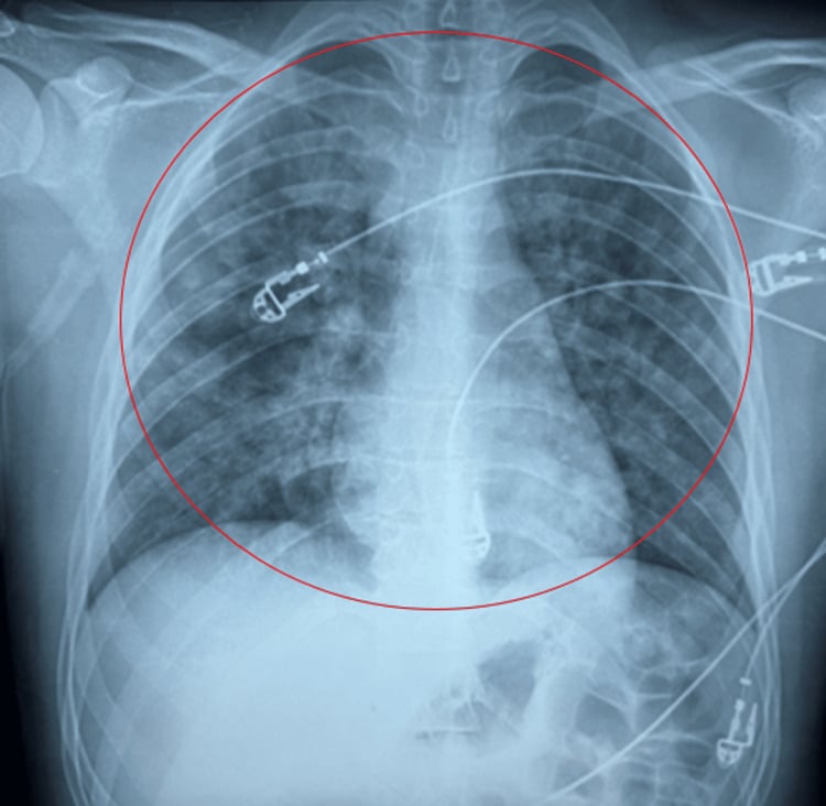ICU chest radiograph showing diffuse bilateral postoperative pulmonary infiltrates (circled)