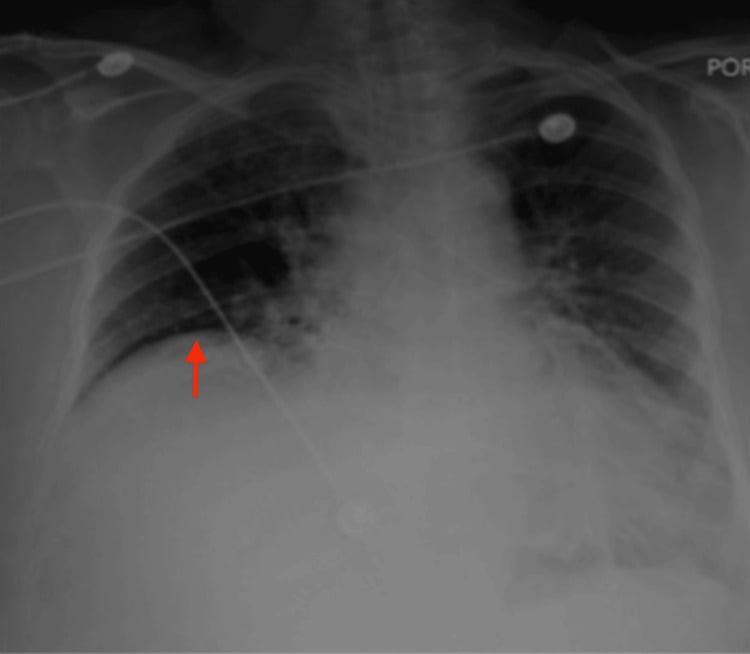 Postoperative chest radiograph showing elevated right hemidiaphragm (arrow) after interscalene block