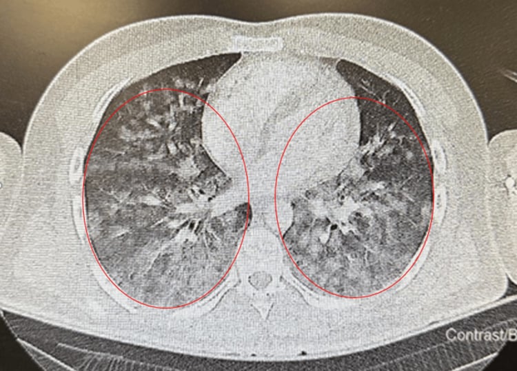 CT pulmonary angiography showing diffuse bilateral ground-glass opacity (circled) without pulmonary embolism