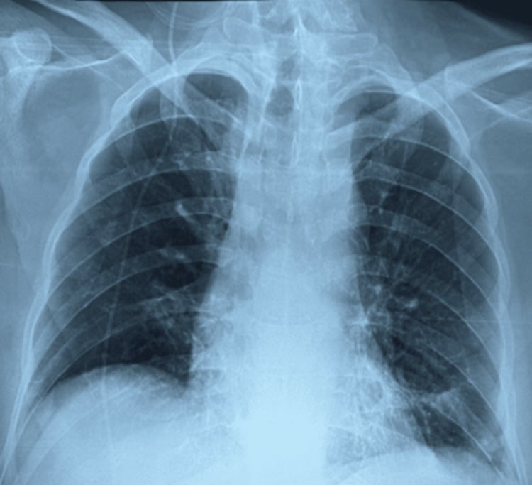 Chest radiograph showing resolution of postoperative bilateral infiltrates
