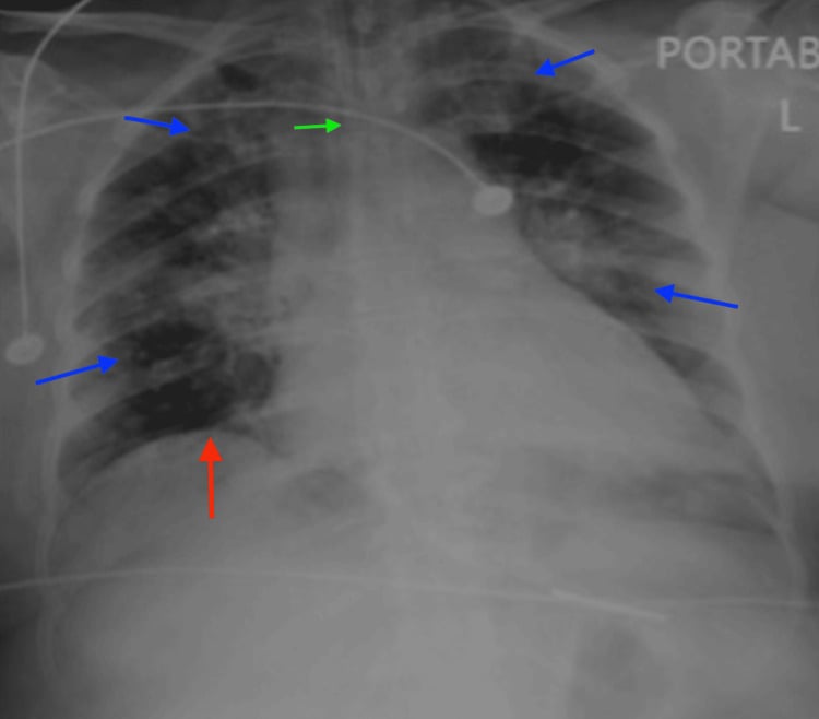 Portable chest radiograph after intubation showing bilateral pulmonary oedema and an elevated right hemidiaphragm