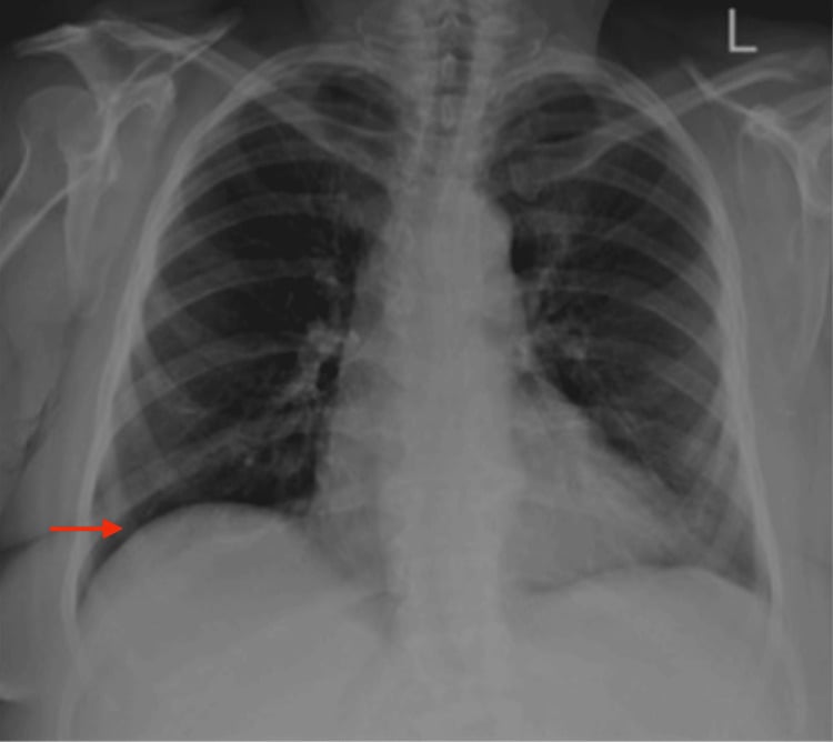 Preoperative chest radiograph showing normal right hemidiaphragm position (arrow)