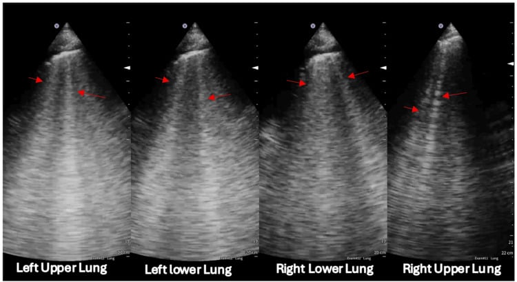 Lung ultrasound showing B-lines in the left upper, left lower, right lower and right upper lung zones in pulmonary oedema