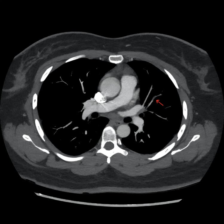 CT pulmonary angiography showing a subtle subsegmental pulmonary embolus (arrow)