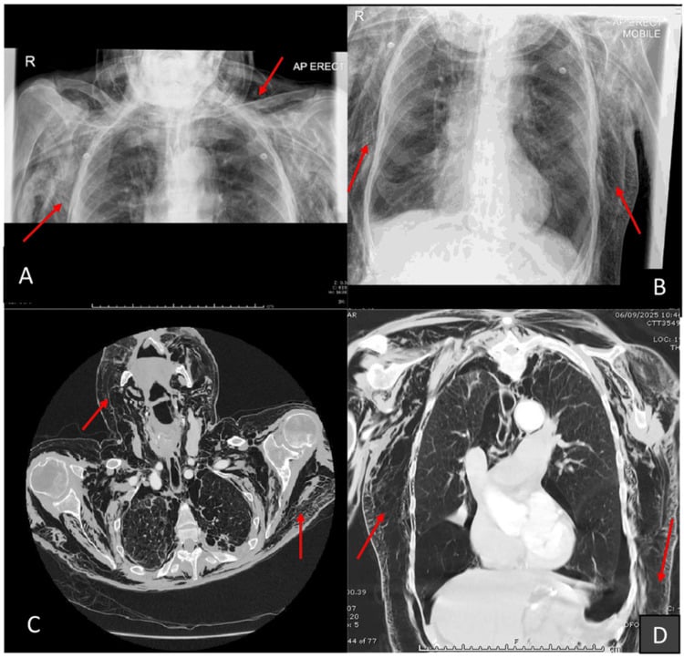 Chest radiographs and axial and coronal CT showing extensive surgical emphysema of the chest wall and neck in bullous COPD