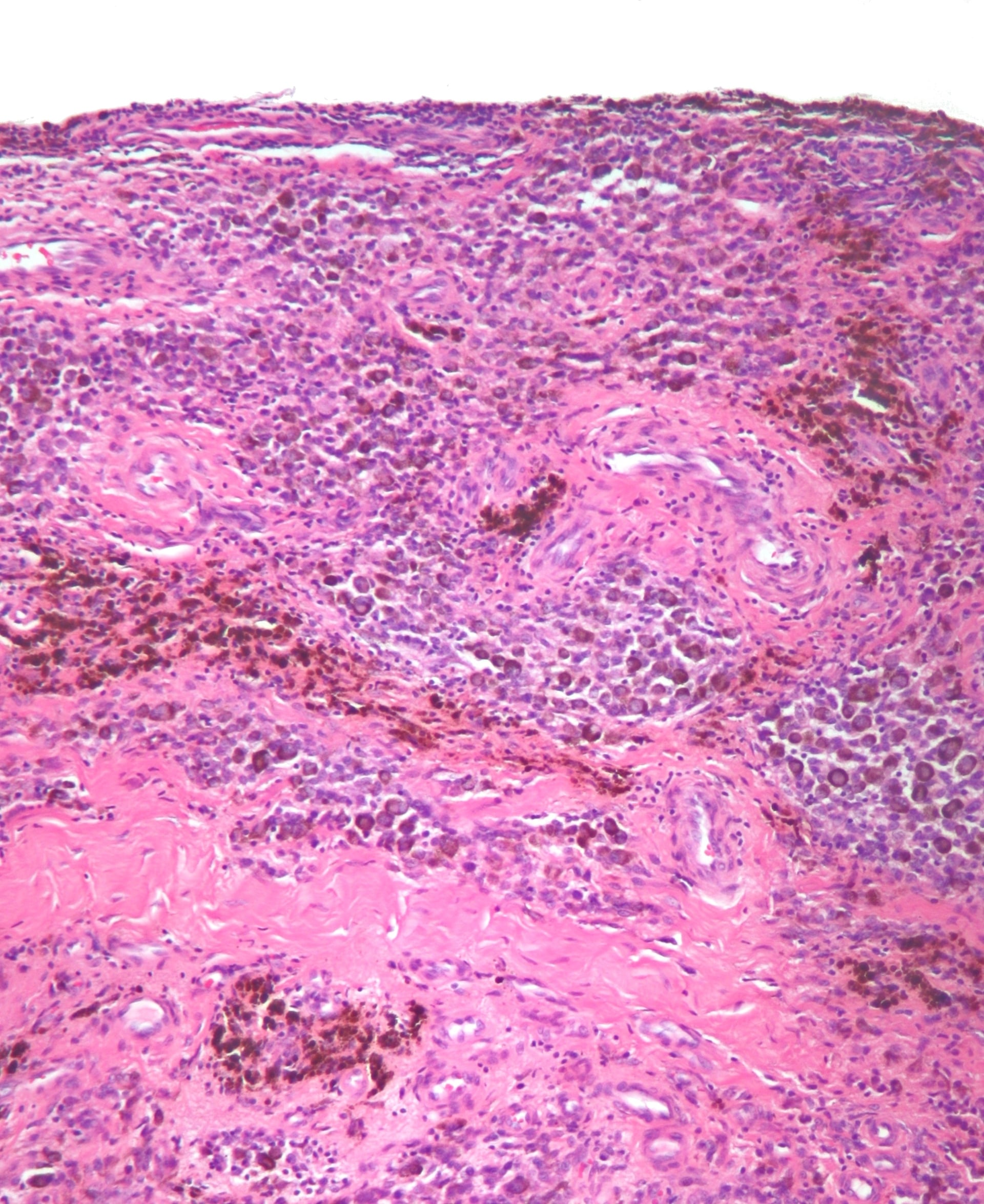 High-power H&E micrograph of pigmented villonodular synovitis showing a cellular synovial proliferation with multinucleated giant cells and abundant golden-brown hemosiderin pigment.