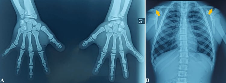 Hand and chest radiographs demonstrating Pycnodysostosis acro-osteolysis and clavicular dysplasia