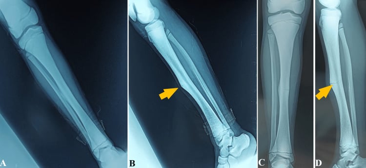 Lower limb radiographs demonstrating Camurati-Engelmann disease diaphyseal cortical hyperostosis