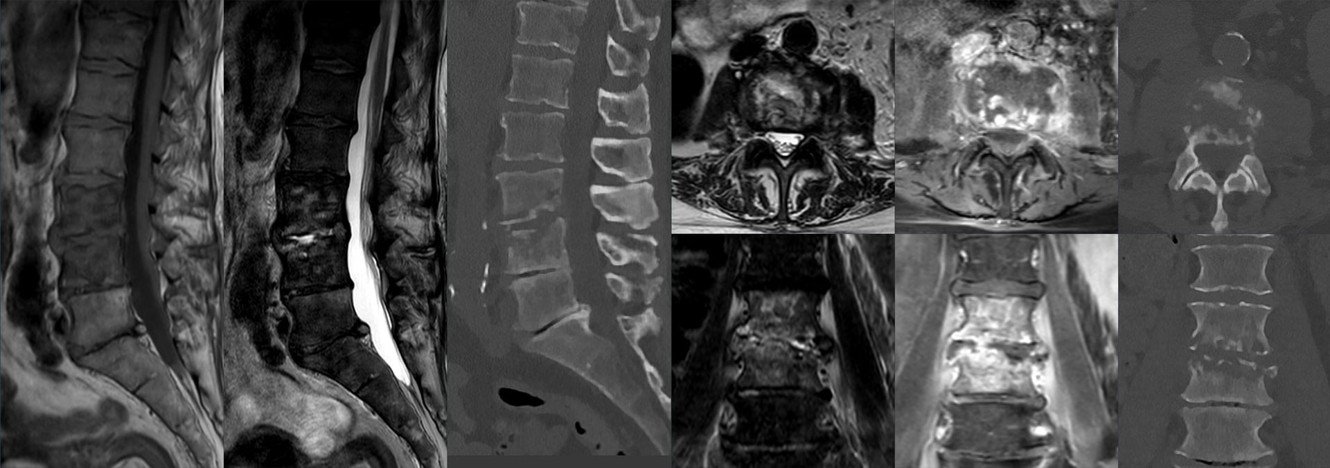 Multi-sequence MRI and CT of L3/4 spondylodiscitis: sagittal T1, T2, axial and coronal T2/STIR, post-contrast T1 fat-saturated MRI, and CT bone-window images in three planes