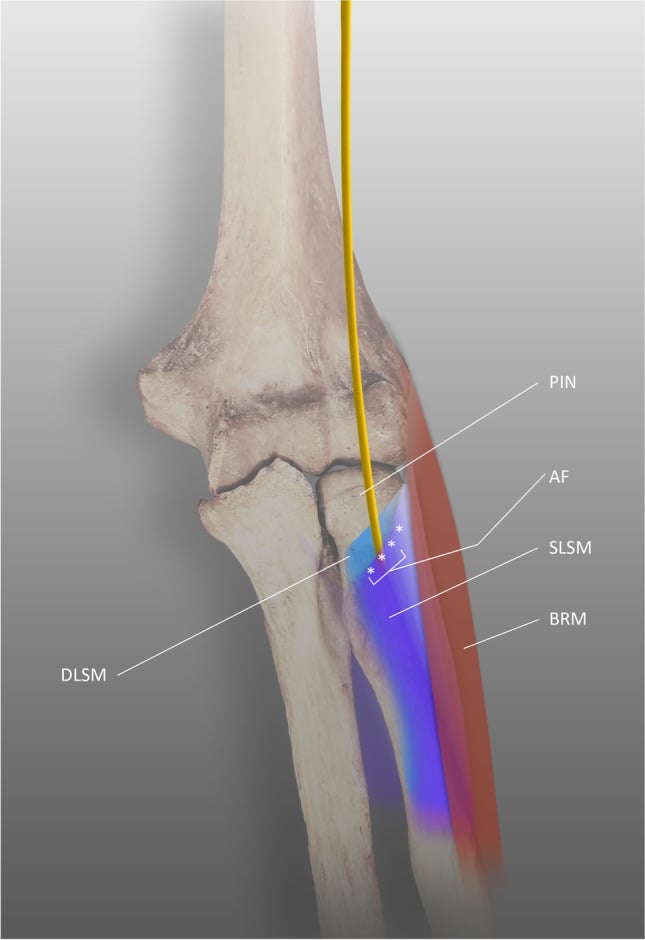 Illustration of the posterior interosseous nerve passing beneath the arcade of Frohse between supinator layers