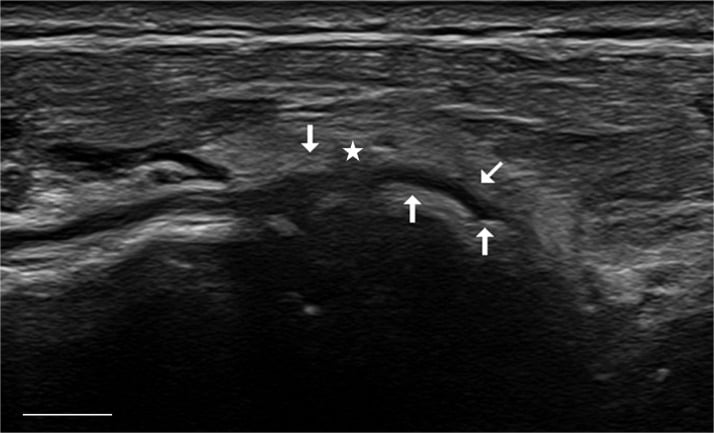 Longitudinal ultrasound showing focal compression of the posterior interosseous nerve over a radial exostosis at the distal supinator