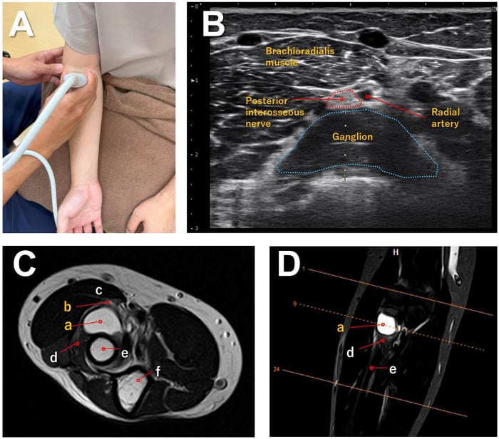 Probe position, short-axis ultrasound and MRI showing a ganglion compressing the posterior interosseous nerve