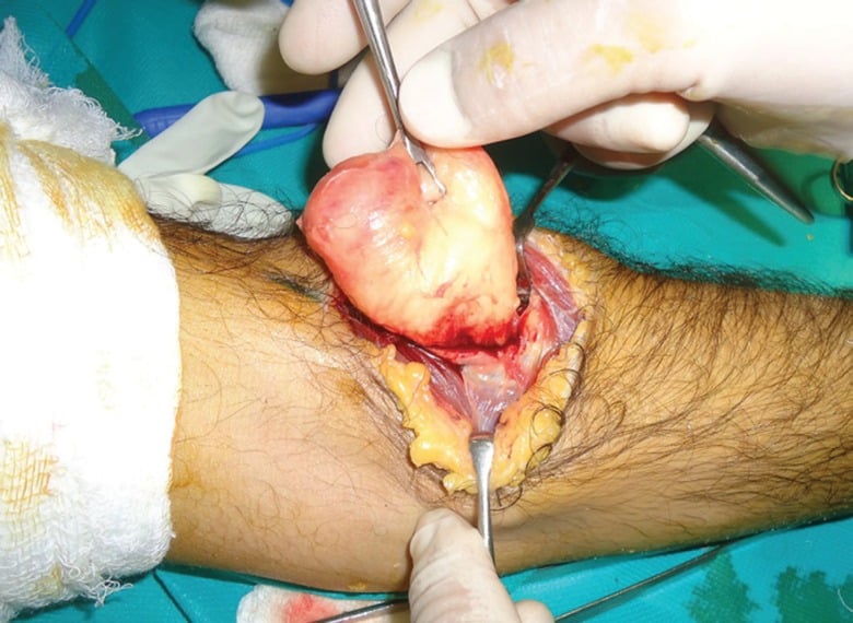 Operative dissection of a proximal radial parosteal lipoma with protected PIN branches