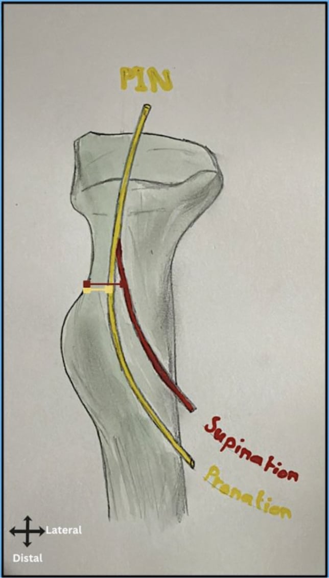 Illustration comparing posterior interosseous nerve distance from the radial tuberosity in pronation and supination
