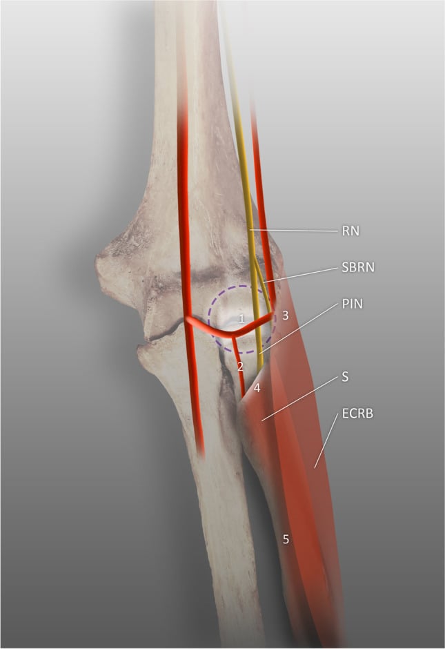 Illustration mapping five radial tunnel compression sites along the radial nerve and PIN