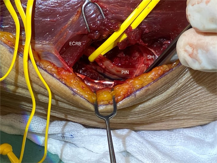 Operative exposure of the posterior interosseous nerve beside ECRB and supinator