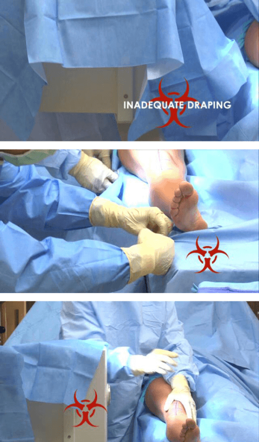 Radiation protection equipment and positioning during orthopaedic fluoroscopy