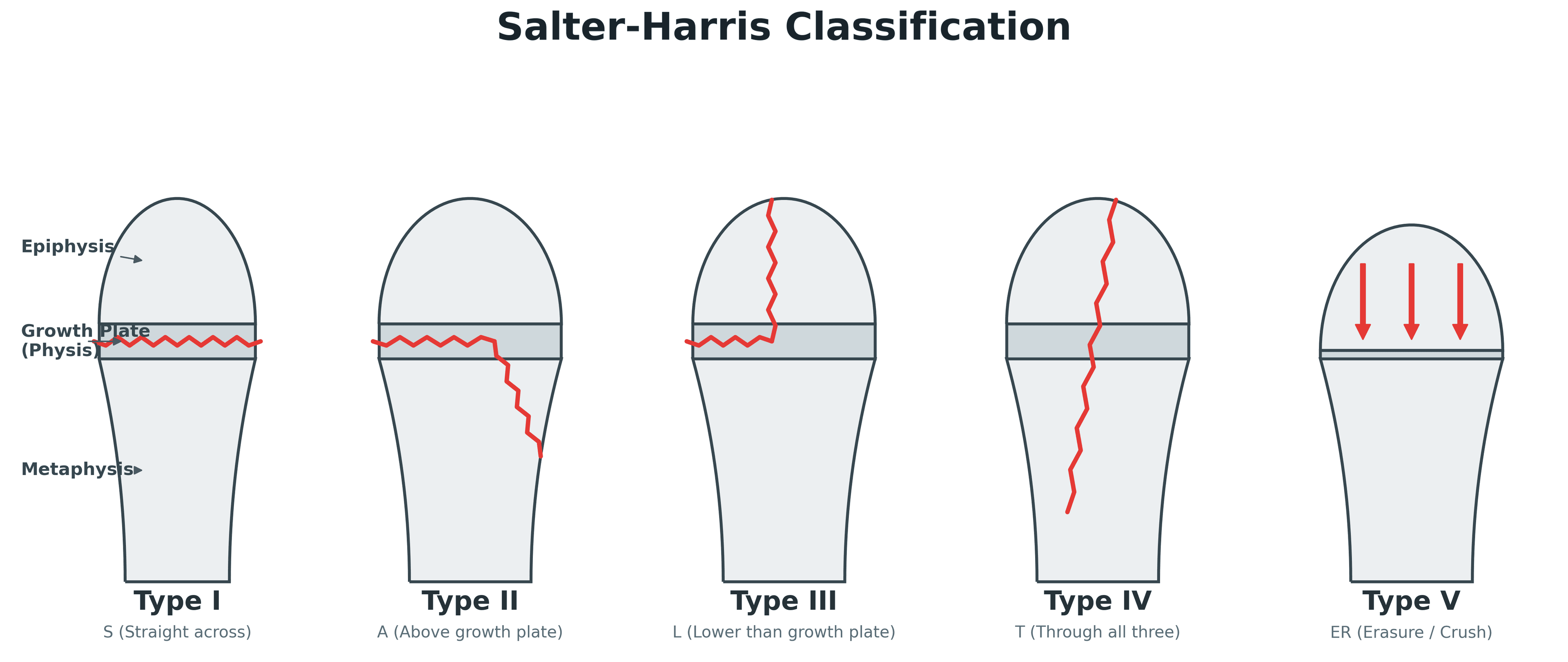 Salter-Harris classification of growth-plate (physeal) fractures, types I to V