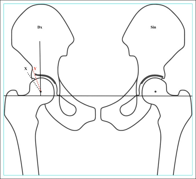 Pelvis radiograph and schematic showing teardrop reference line and acetabular index measurement