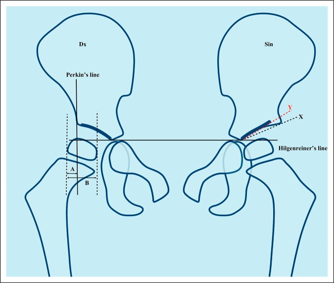 Diagram of pediatric pelvis showing Hilgenreiner, Perkins and Shenton lines
