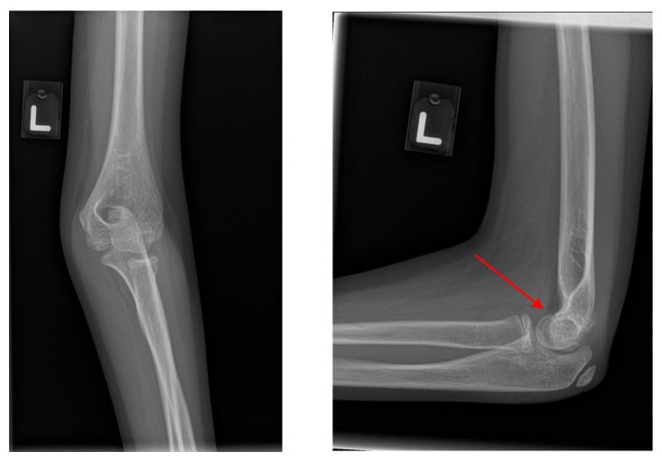 Elbow radiograph highlighting the distal humeral physis to distinguish it from a fracture line