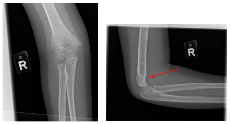 AP and lateral elbow radiographs showing posterior fat pad sign in an undisplaced supracondylar fracture
