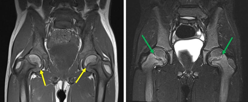 Coronal T1 and STIR MRI of bilateral hips showing Legg-Calve-Perthes disease