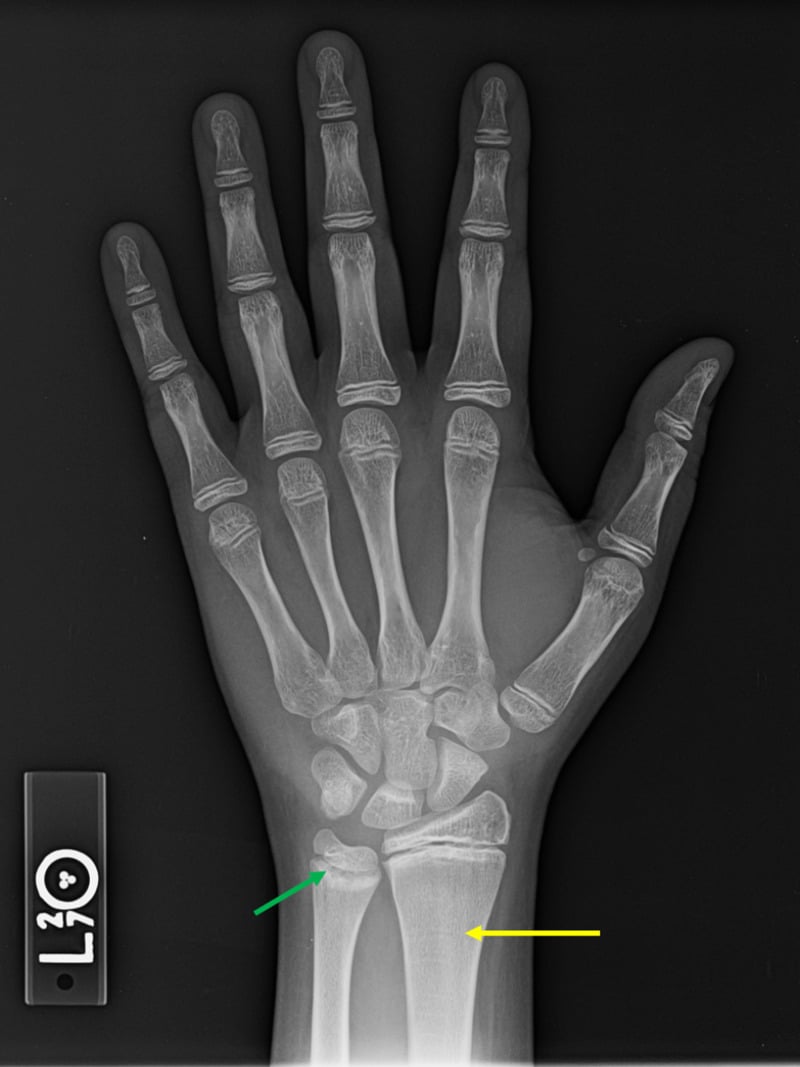 Bone age radiograph of the left hand and wrist for Greulich and Pyle assessment