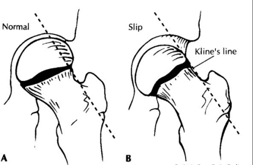 Diagram comparing Klein's line on normal hip and slipped capital femoral epiphysis