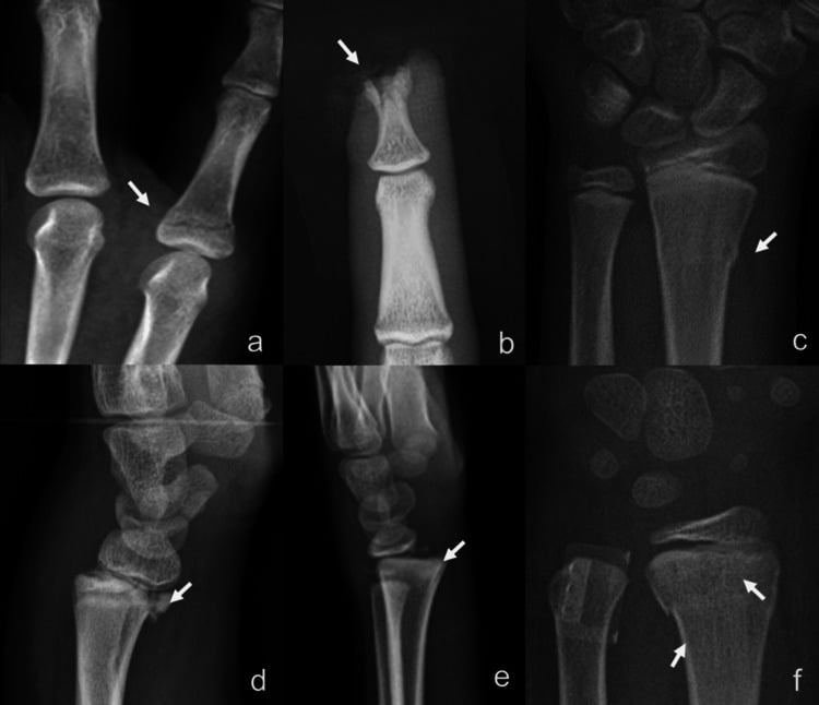 Radiographs illustrating paediatric fracture types including torus and Salter-Harris fractures