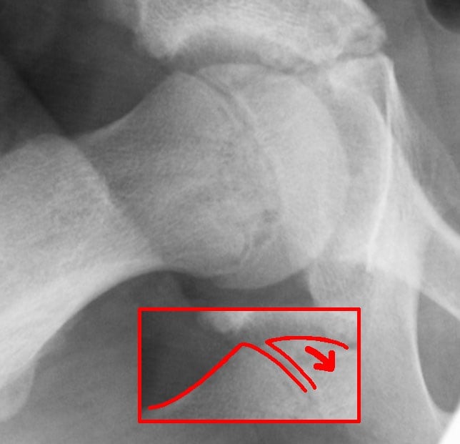 Hip radiograph with Klein line drawn along the superior femoral neck (Trethowan sign for SUFE)