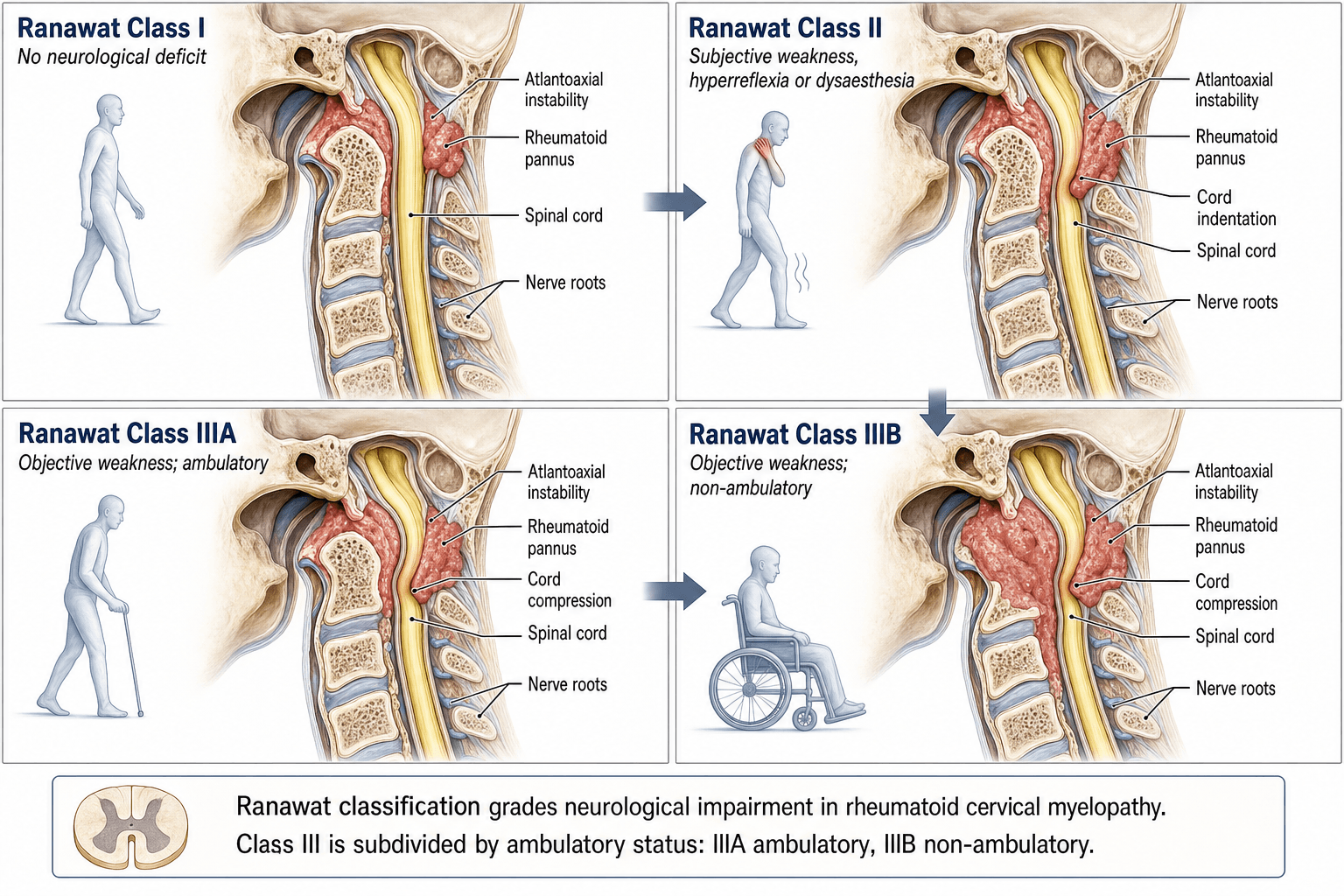 Ranawat Classification of Cervical Myelopathy in Rheumatoid Arthritis